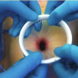 Medical publication visual for Use of the Alexis® Wound Protector for Exposure and Sterility in Perianal Oncologic Surgery: A Technical Report