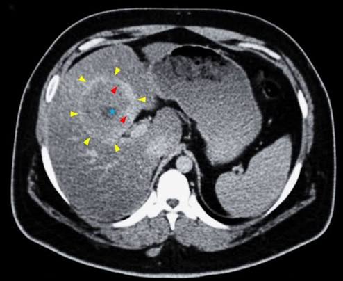 Medical publication visual for Open Parenchyma-Preserving Enucleation of Giant Hepatic Hemangiomas: A Systematic CUSA-Guided Pringle-Free Technique