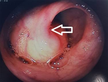 Medical publication visual for Laparoscopic Management of Large Colonic Lipoma with Atypical Presentation: A Case Report