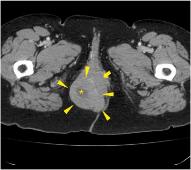 Medical publication visual for Sphincter-Preserving Intersphincteric Resection for Perianal GIST Following Neoadjuvant Imatinib: Case Report and Literature Review