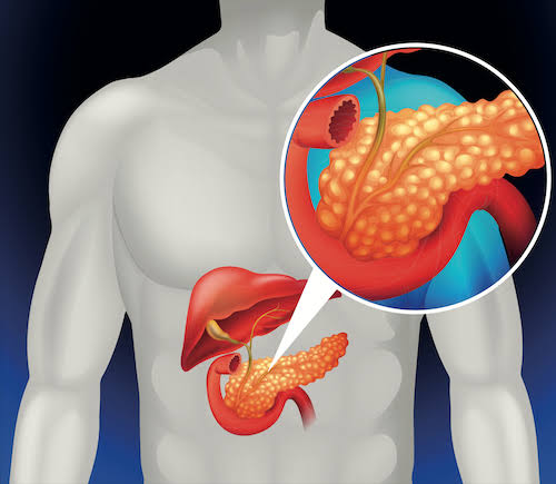 Medical illustration for Benign GI, Hepatobiliary & General Surgical Conditions